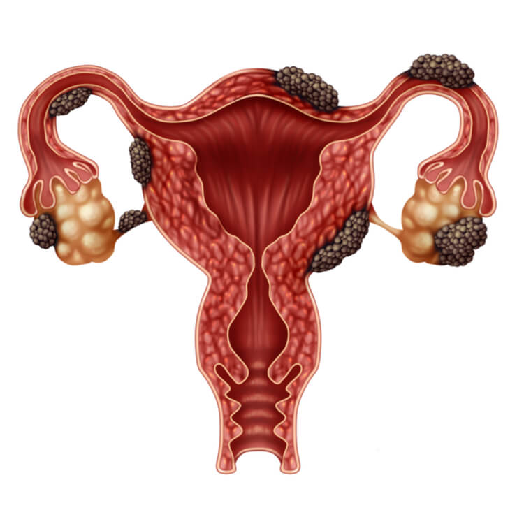 endometriosi-cellule endometriali-diffuse